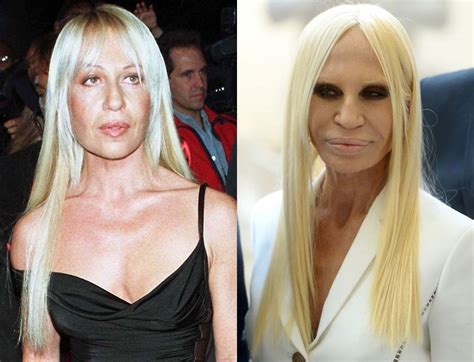 donatella versace antes de operarse|Donatella Versace Before and After Plastic Surgery Journey.